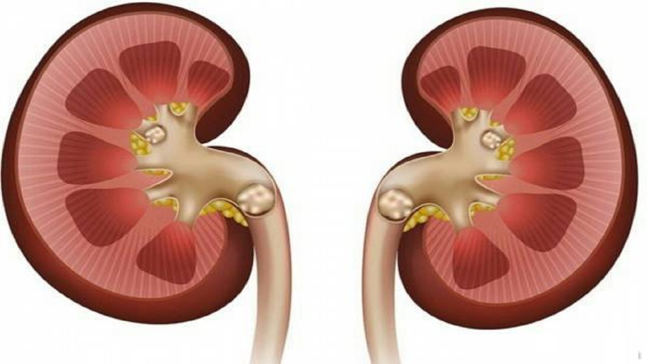 کلیه های این افراد سنگ ساز است کلیه های این افراد سنگ ساز است