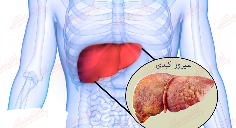 هرآنچه باید در مورد سیروز کبدی بدانید هرآنچه باید در مورد سیروز کبدی بدانید