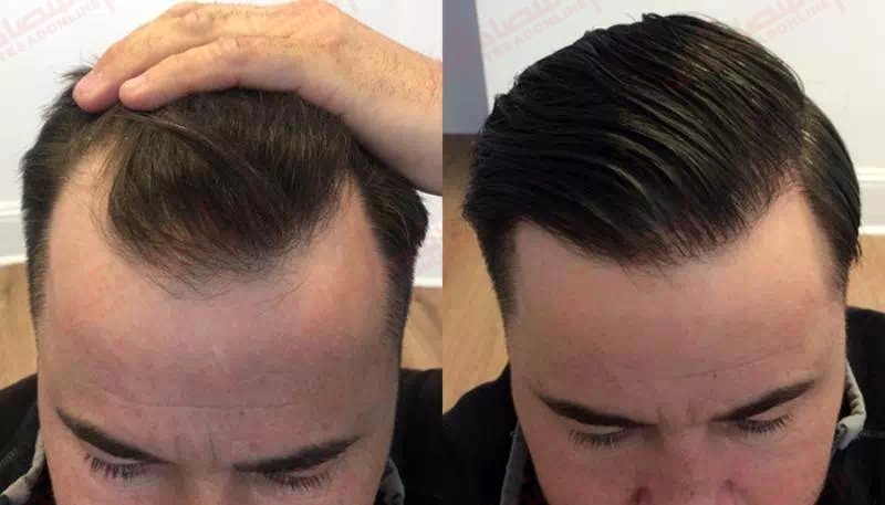 هرآنچه باید درباره کاشت مو از روش استخراج واحد فولیکولی دانست هرآنچه باید درباره کاشت مو از روش استخراج واحد فولیکولی دانست
