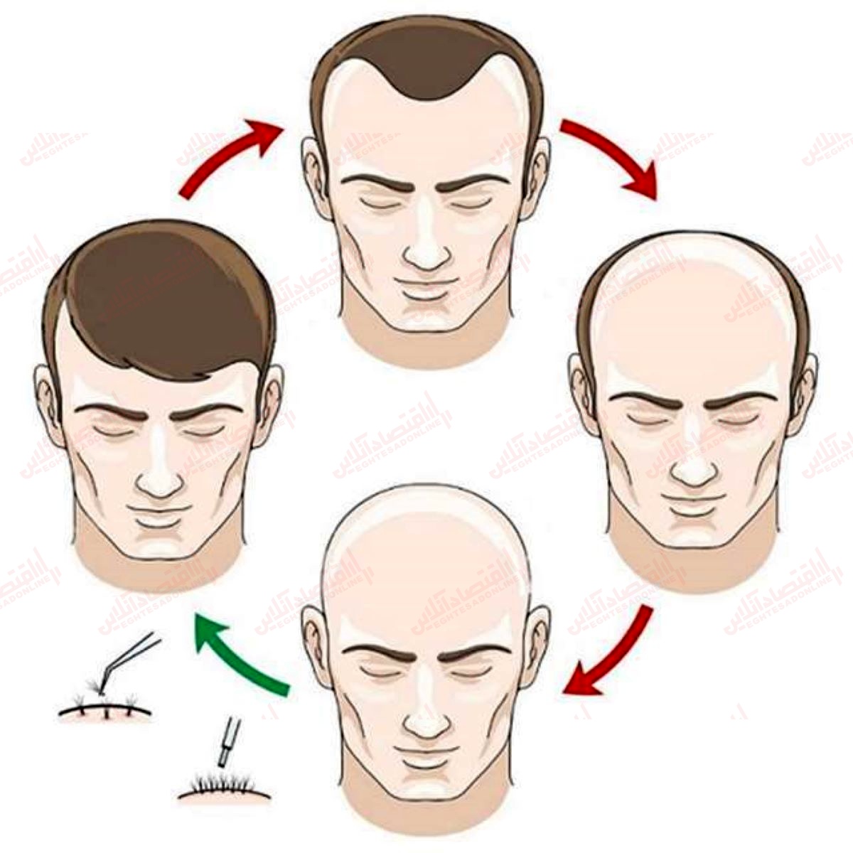هرآنچه در مورد کاشت مو باید دانست هرآنچه در مورد کاشت مو باید دانست