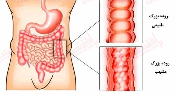 انواع بیماری های التهابی روده در بزرگسالان