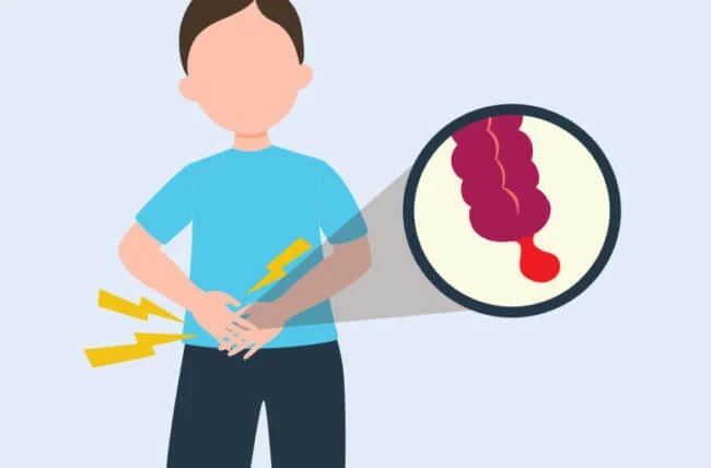 درباره آپاندیس بیشتر بدانیم درباره آپاندیس بیشتر بدانیم