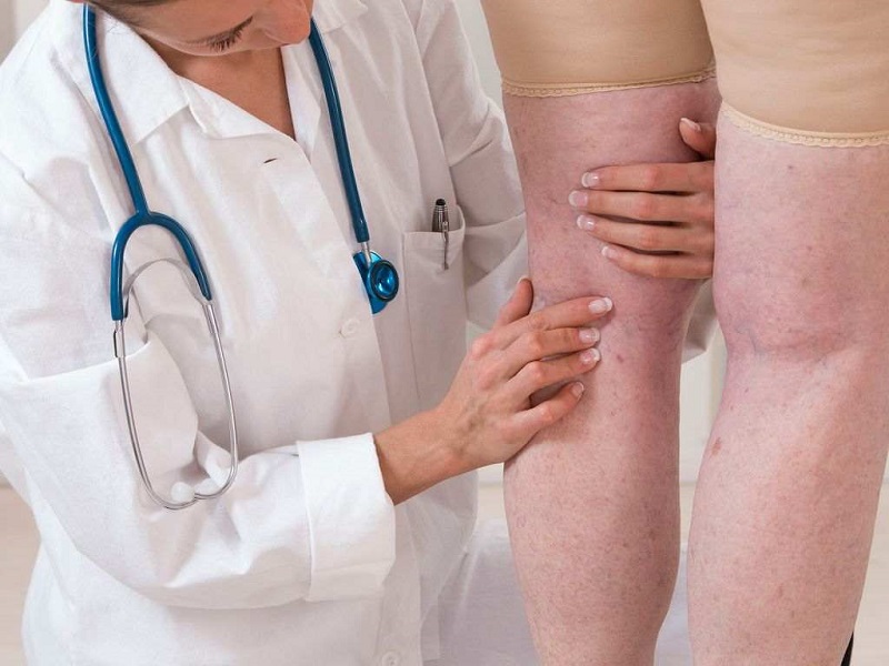 رگ های واریسی اغلب در چه کسانی دیده می شود؟ رگ های واریسی اغلب در چه کسانی دیده می شود؟
