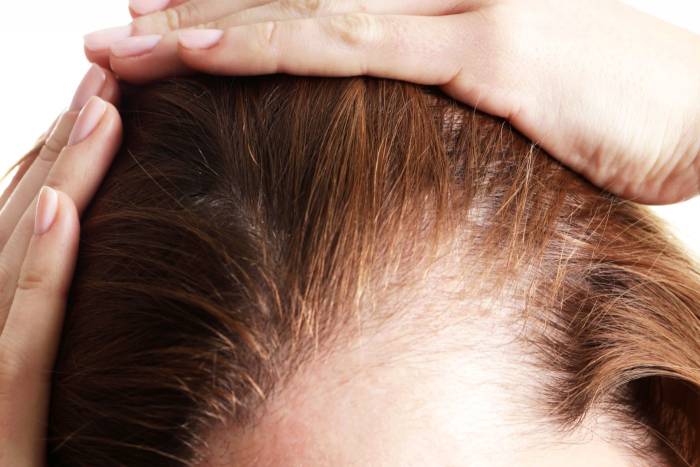 دلیل اصلی ریزش مو در سنین جوانی چیست؟ دلیل اصلی ریزش مو در سنین جوانی چیست؟
