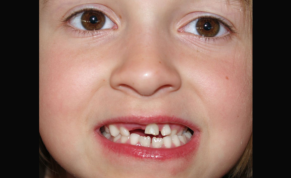 تشخیص اختلالات سلامت روان کودک با بررسی دندان شیری تشخیص اختلالات سلامت روان کودک با بررسی دندان شیری