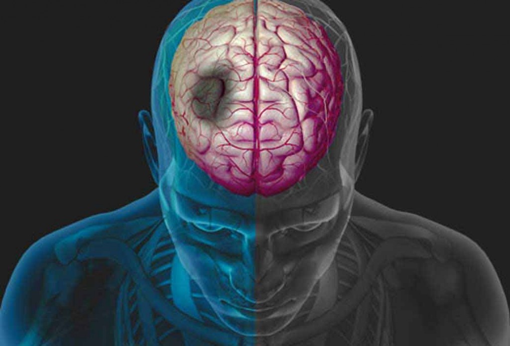سکته مغزی چه ارتباطی با رژیم غذایی دارد؟ سکته مغزی چه ارتباطی با رژیم غذایی دارد؟