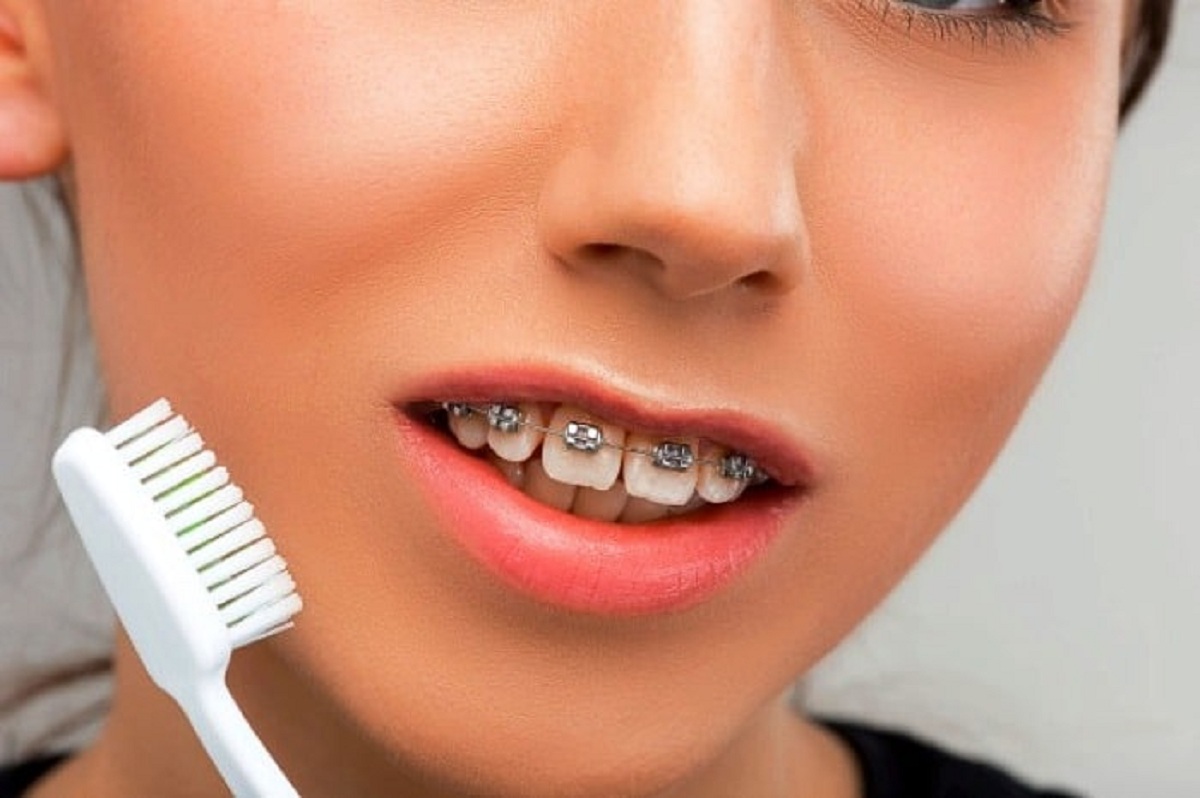 چه وقت می توانیم ارتودنسی کنیم؟ چه وقت می توانیم ارتودنسی کنیم؟