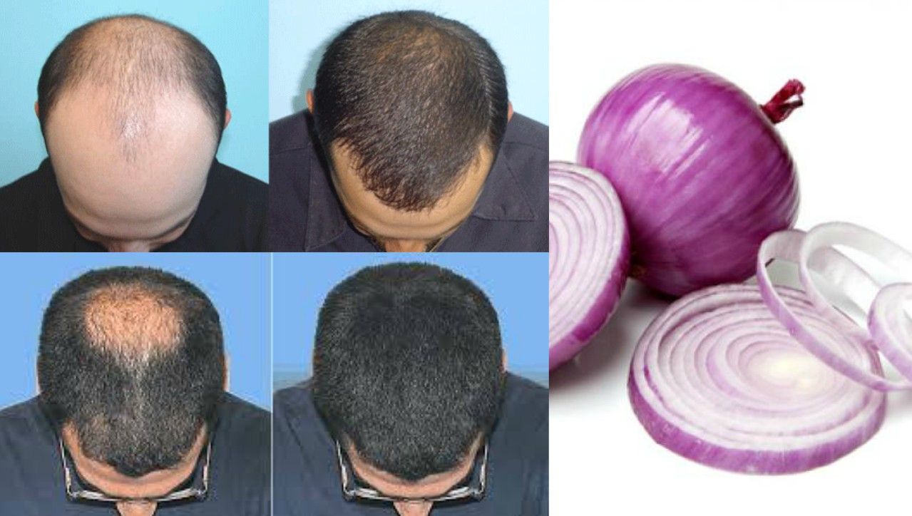 فواید آب پیاز روی مو و درمان طاسی فواید آب پیاز روی مو و درمان طاسی