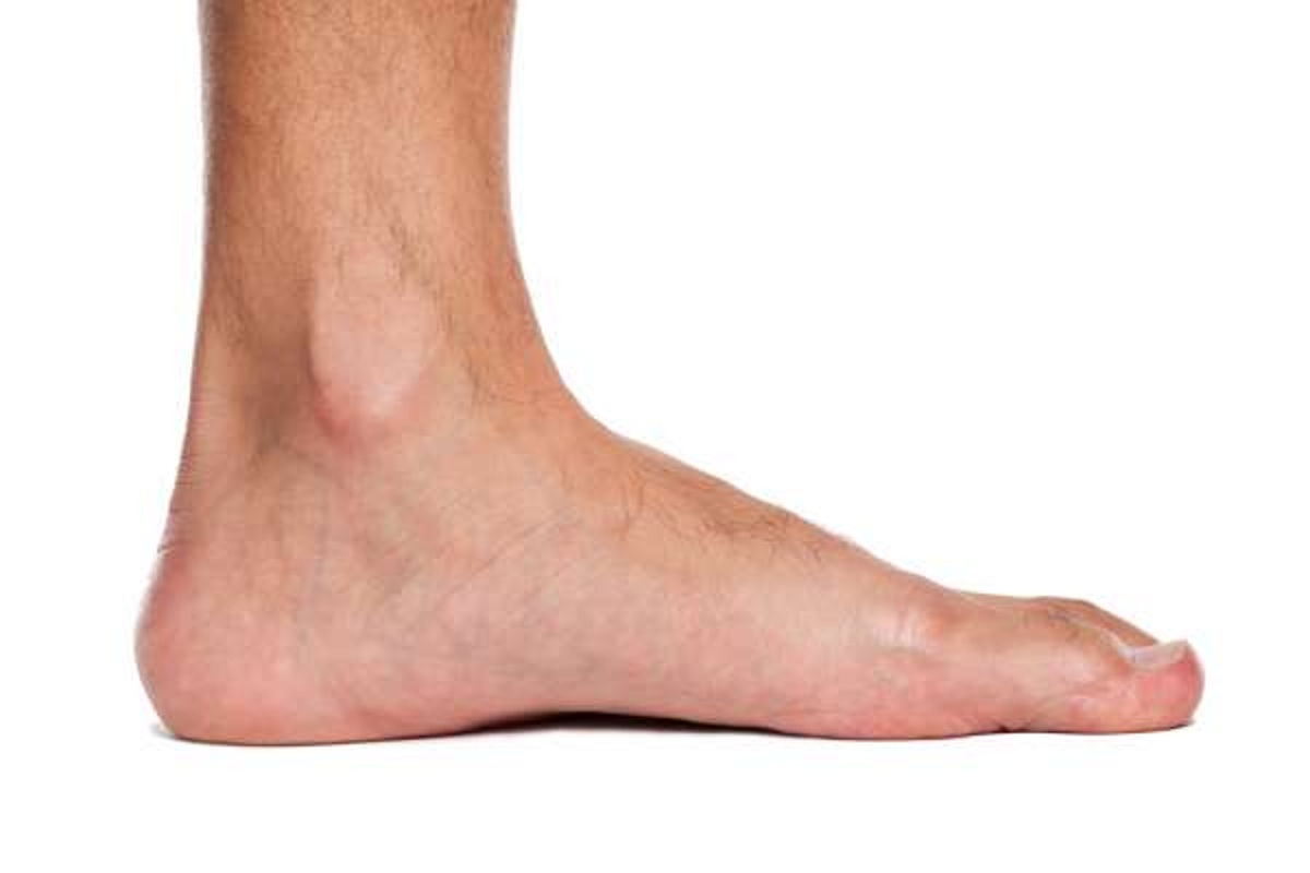 علت و عوارض کف پای صاف