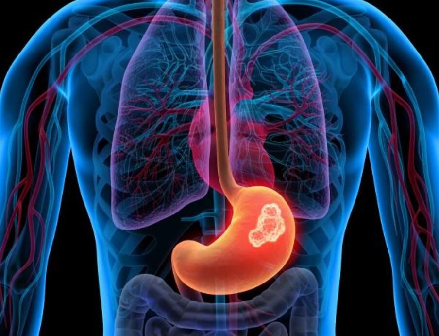 علائم و راهکارهای درمانی سرطان معده