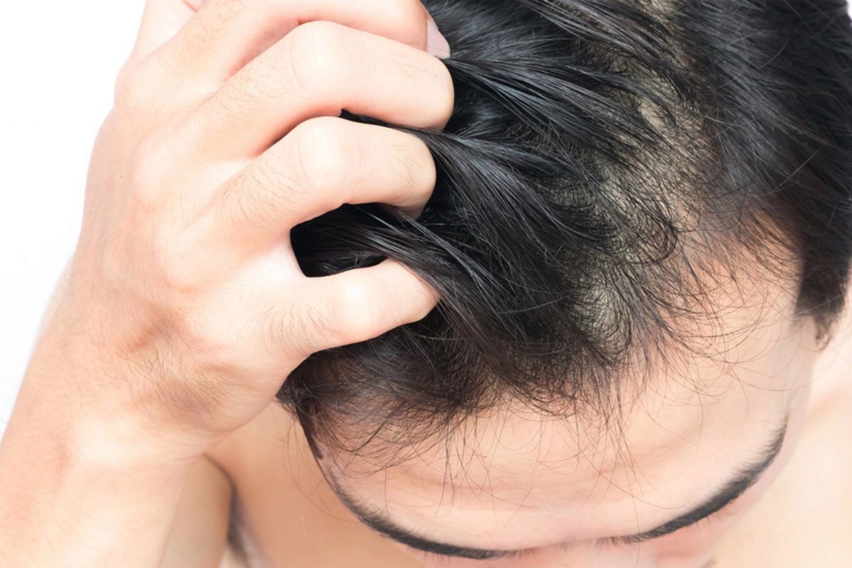 خشکی پوست سر را چگونه درمان کنیم؟ خشکی پوست سر را چگونه درمان کنیم؟