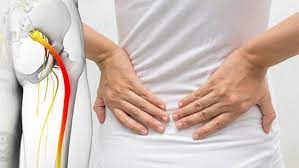 سیاتیک چیست و چه علائمی دارد؟ سیاتیک چیست و چه علائمی دارد؟