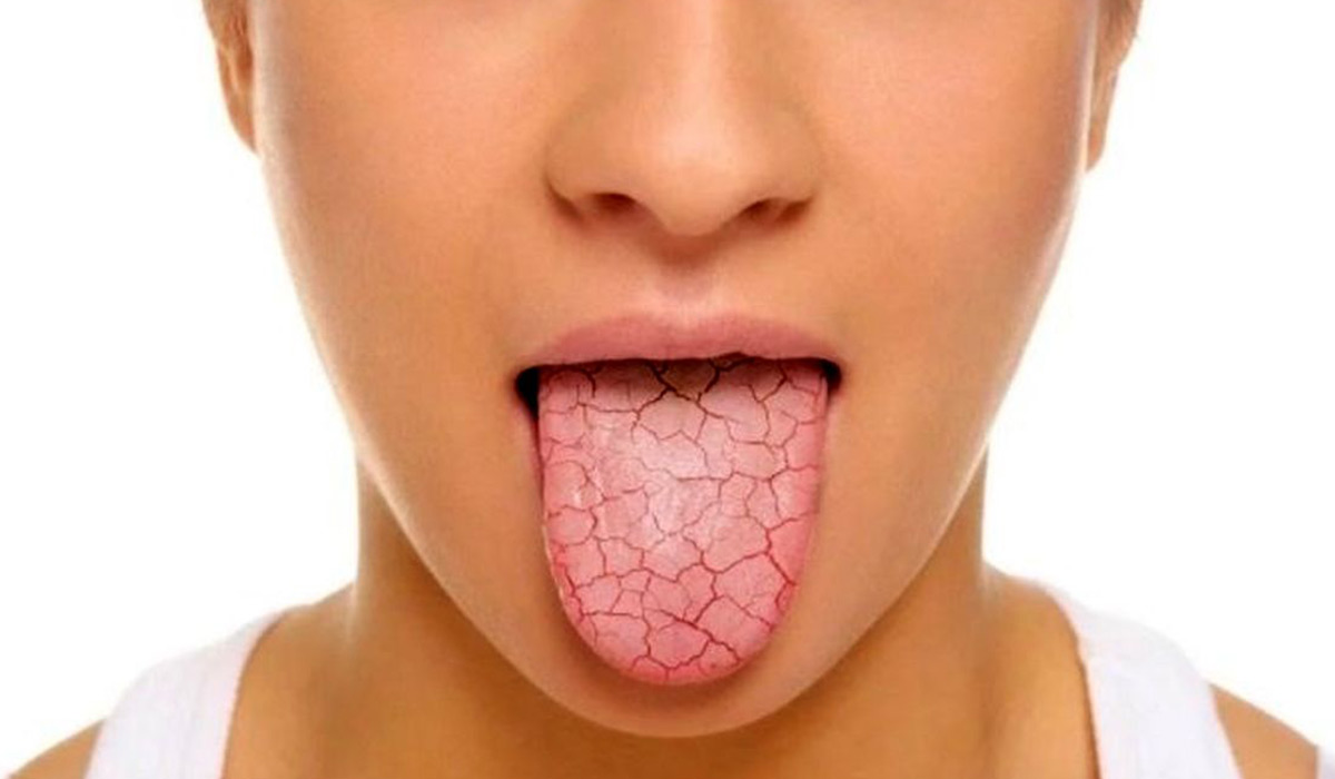 علت خشکی دهان چیه؟ علت خشکی دهان چیه؟