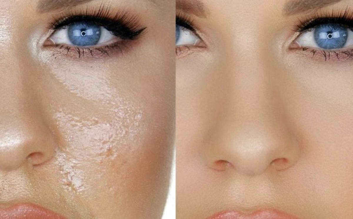 اسرار زیبایی؛ چطور چربی پوست را کاهش دهیم؟ اسرار زیبایی؛ چطور چربی پوست را کاهش دهیم؟
