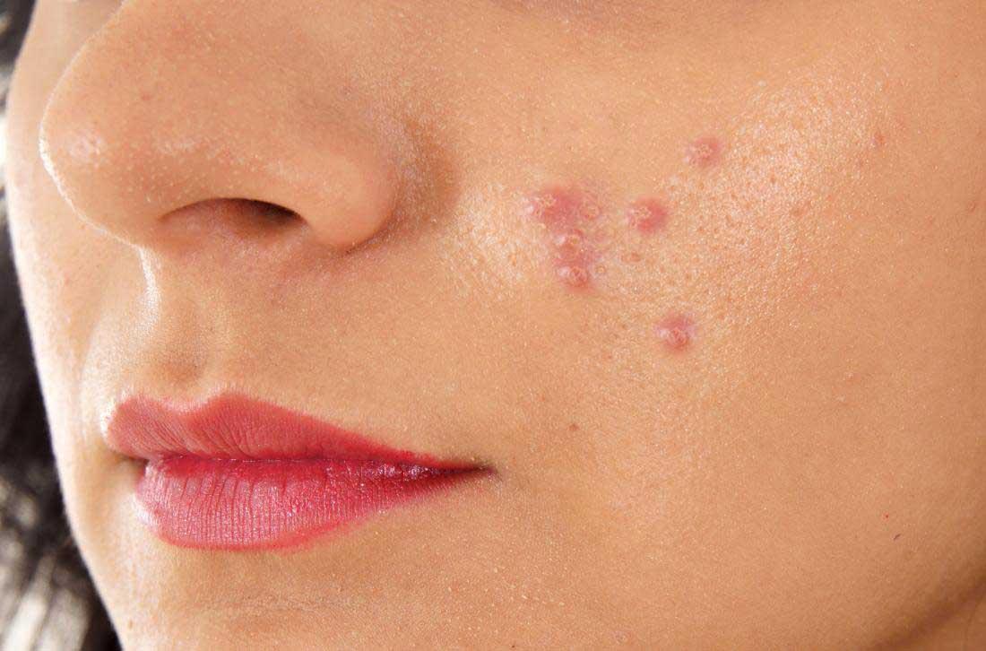دلایل بروز جوش های چرکی روی صورت و راه های ساده درمانی دلایل بروز جوش های چرکی روی صورت و راه های ساده درمانی