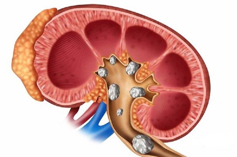 برای جلوگیری از ایجاد سنگ کلیه چه کنیم؟ برای جلوگیری از ایجاد سنگ کلیه چه کنیم؟