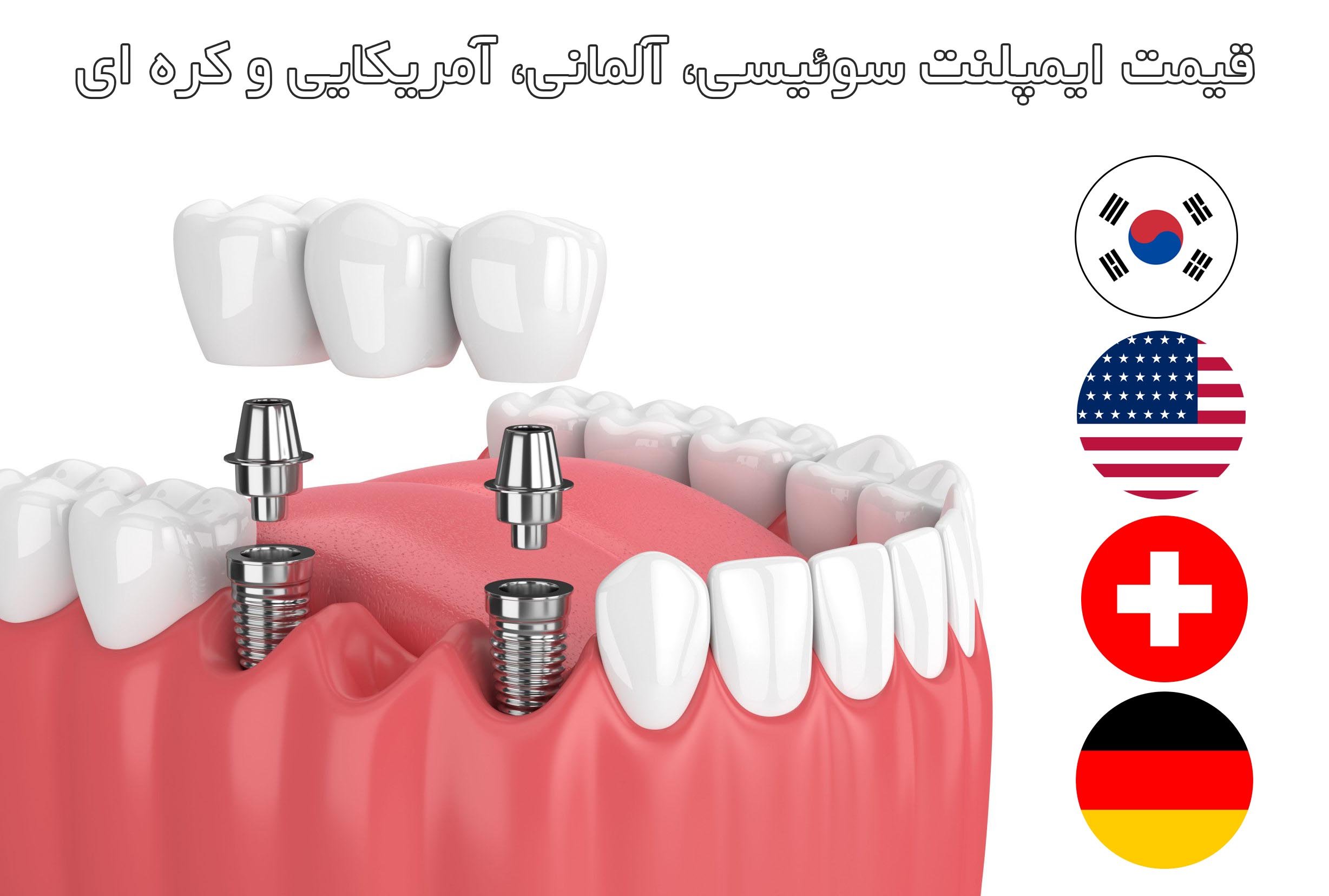 قیمت ایمپلنت سوئیسی، آلمانی، آمریکایی و کره ای قیمت ایمپلنت سوئیسی، آلمانی، آمریکایی و کره ای