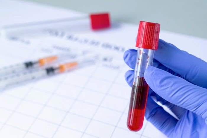 پیشبینی زوال عقل از طریق آزمایش خون! پیشبینی زوال عقل از طریق آزمایش خون!