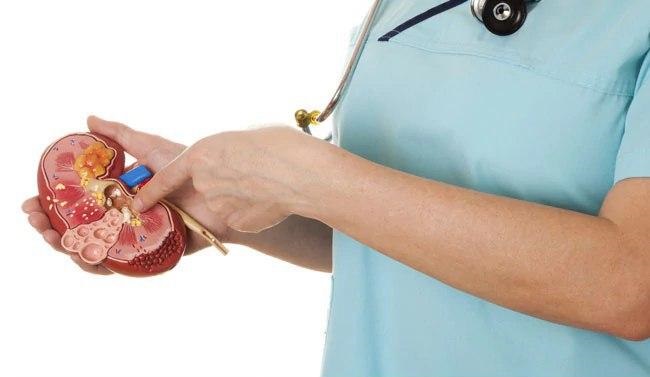 برای پیشگیری از عود سنگ کلیه چه کنیم؟ برای پیشگیری از عود سنگ کلیه چه کنیم؟
