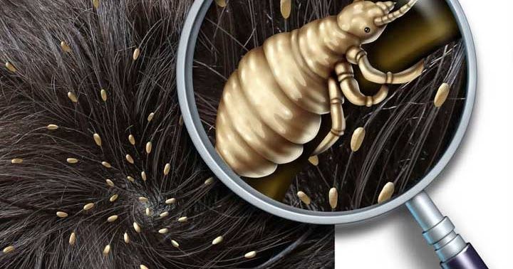 تفاوت و فرق اصلی شوره سر و شپش + روش تشخیص