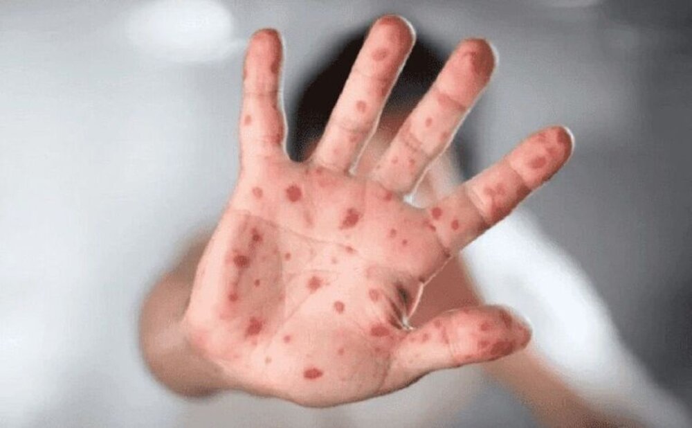 سرایت آبله میمونی از طریق هوا چقدر است؟