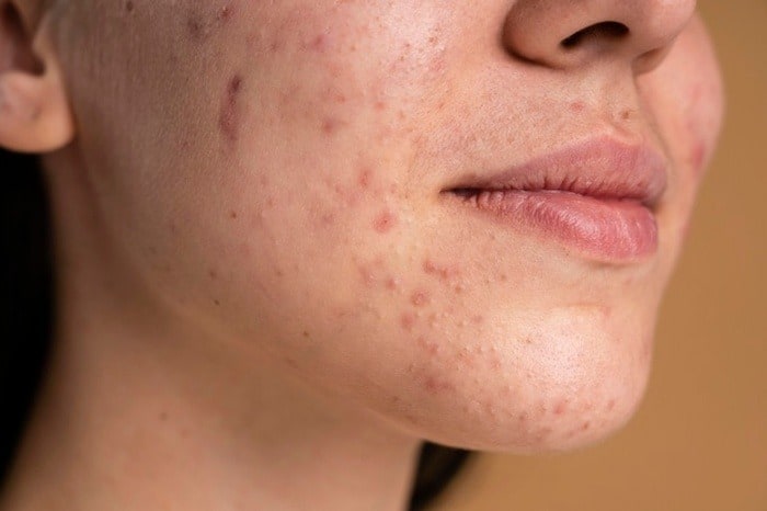 چگونه صورتی بدون جوش و لک داشته باشیم؟ چگونه صورتی بدون جوش و لک داشته باشیم؟