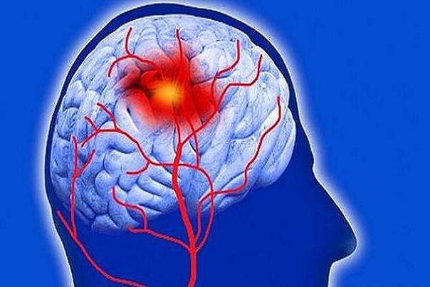 کرونا باعث افزایش سکته مغزی شد کرونا باعث افزایش سکته مغزی شد