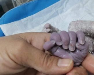 تولد نوزادی با ۲۴ انگشت! + عکس تولد نوزادی با ۲۴ انگشت! + عکس