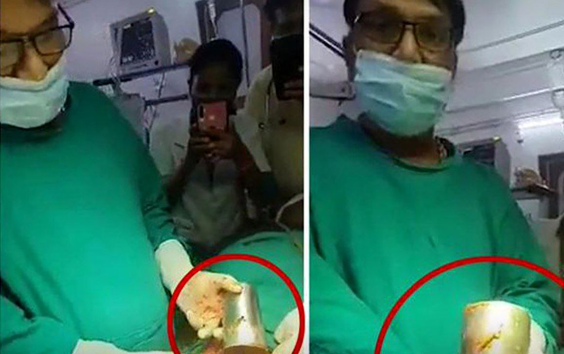 کشف لیوان فولادی در معده یک مرد + عکس