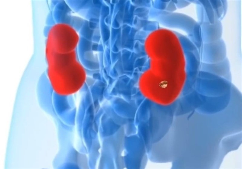 ابداع روشی جدید برای تشخیص سرطان کلیه ابداع روشی جدید برای تشخیص سرطان کلیه