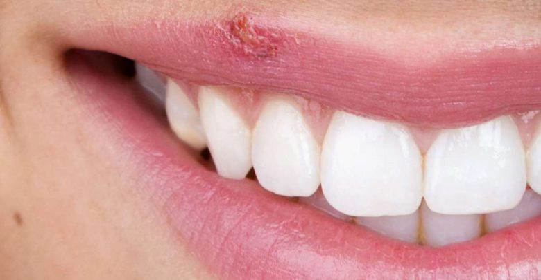 آیا تبخال لب مسری است؟ + درمان خانگی آیا تبخال لب مسری است؟ + درمان خانگی