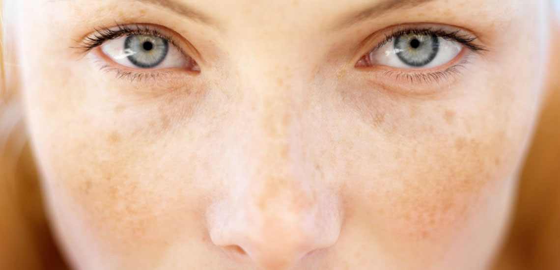 ترفند رفع «کک و مک» ناشی از آفتاب سوختگی