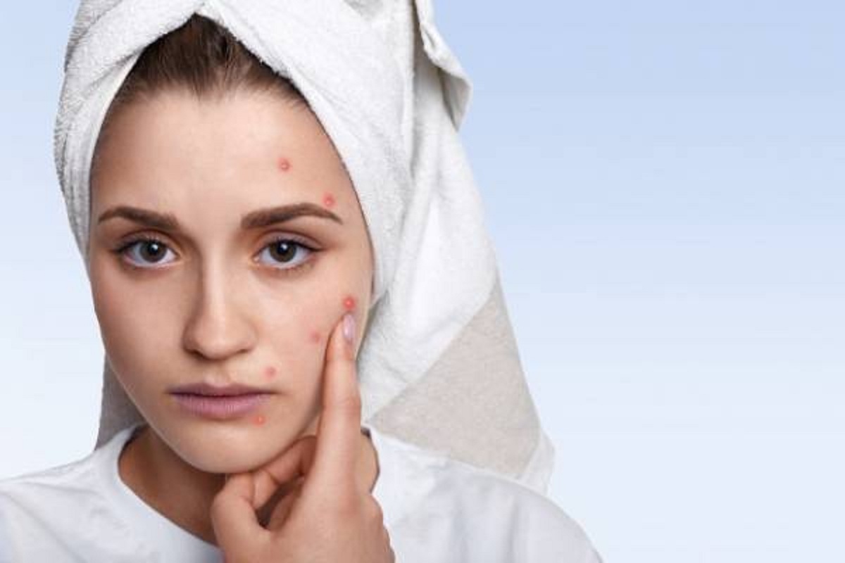 چی بخوریم، بیشتر جوش می زنیم؟ چی بخوریم، بیشتر جوش می زنیم؟