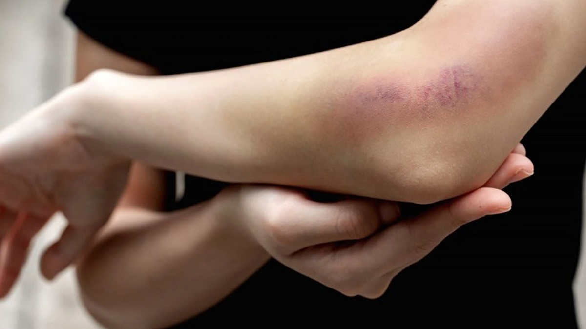 کبودی بدن نگران کننده است؟ + دلیل تغییر رنگ کبودی های پوست
