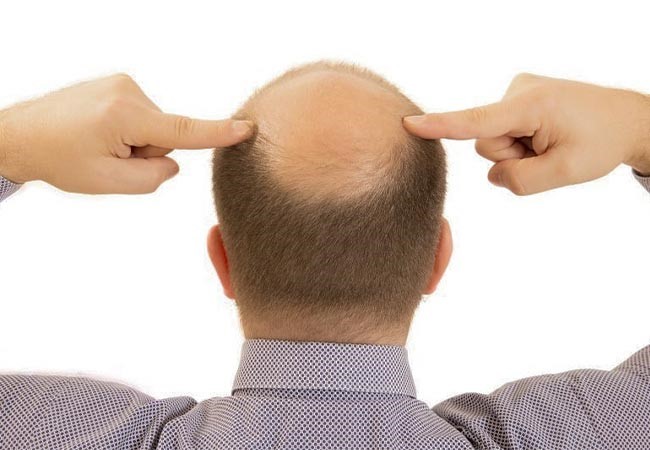 بهترین راه حل های فوری جهت رفع طاسی سر بهترین راه حل های فوری جهت رفع طاسی سر
