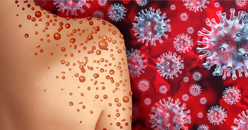 راه اصلی انتقال آبله میمونی چیست؟