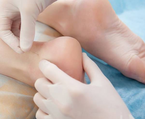 چگونه درد پاشنه پا را درمان کنیم؟ + عکس