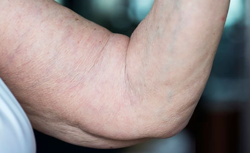 سلولیت چیست؟ + دلیل ، تشدید و درمان قطعی