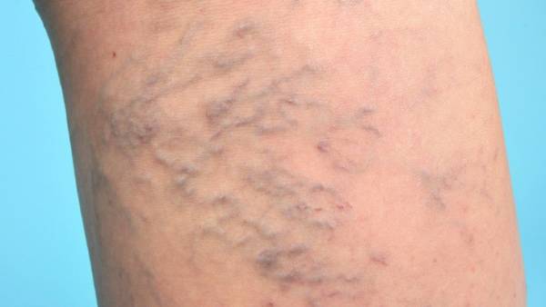 عاداتی که به رگ های پا آسیب می زنند