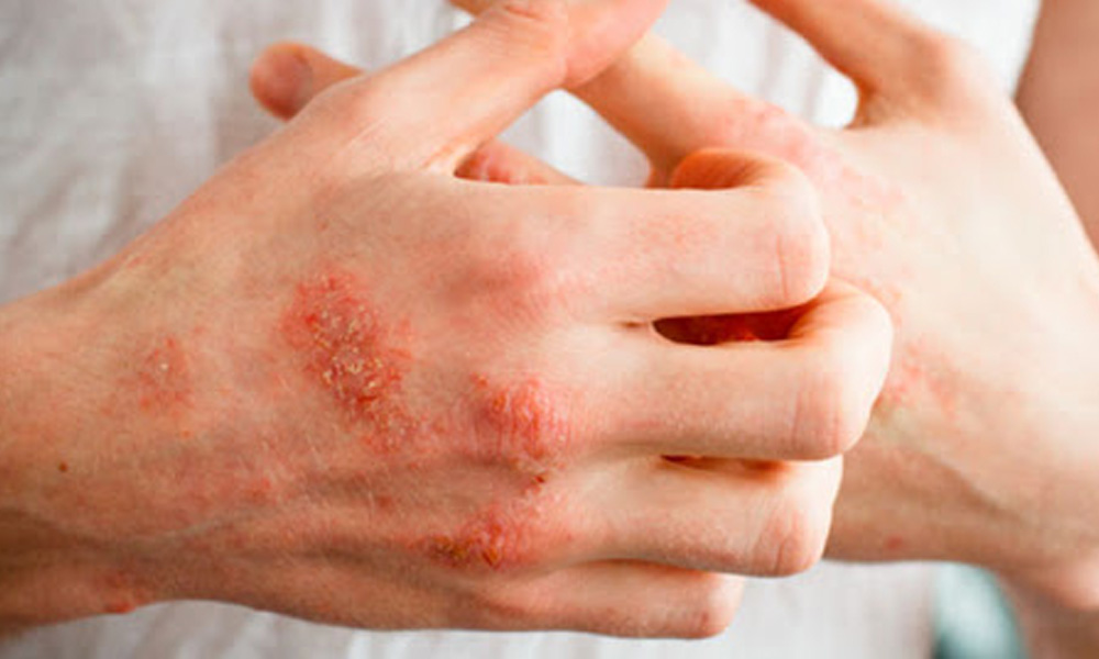 آیا دیابت بر پوست تاثیر می گذارد؟ آیا دیابت بر پوست تاثیر می گذارد؟