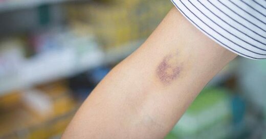 چرا پوست ناگهان کبود می شود؟