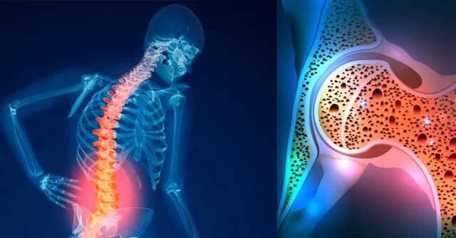 این افراد در معرض پوکی استخوان هستند + علائم این افراد در معرض پوکی استخوان هستند + علائم