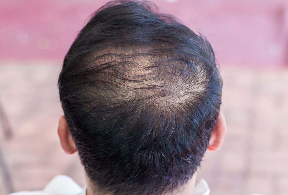 علت نازک شدن مو چیه؟ علت نازک شدن مو چیه؟