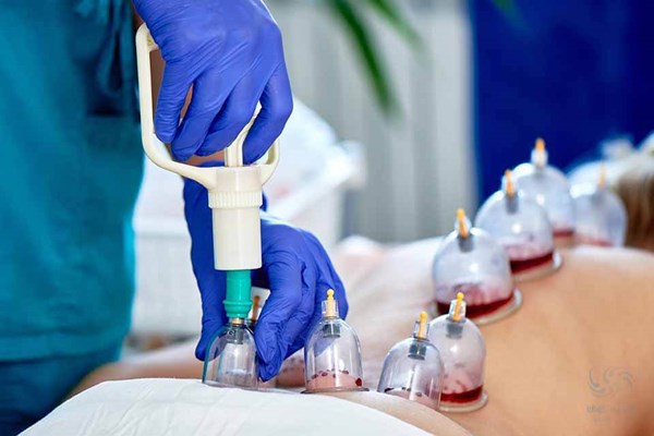 بهترین زمان حجامت چه موقع است؟ بهترین زمان حجامت چه موقع است؟
