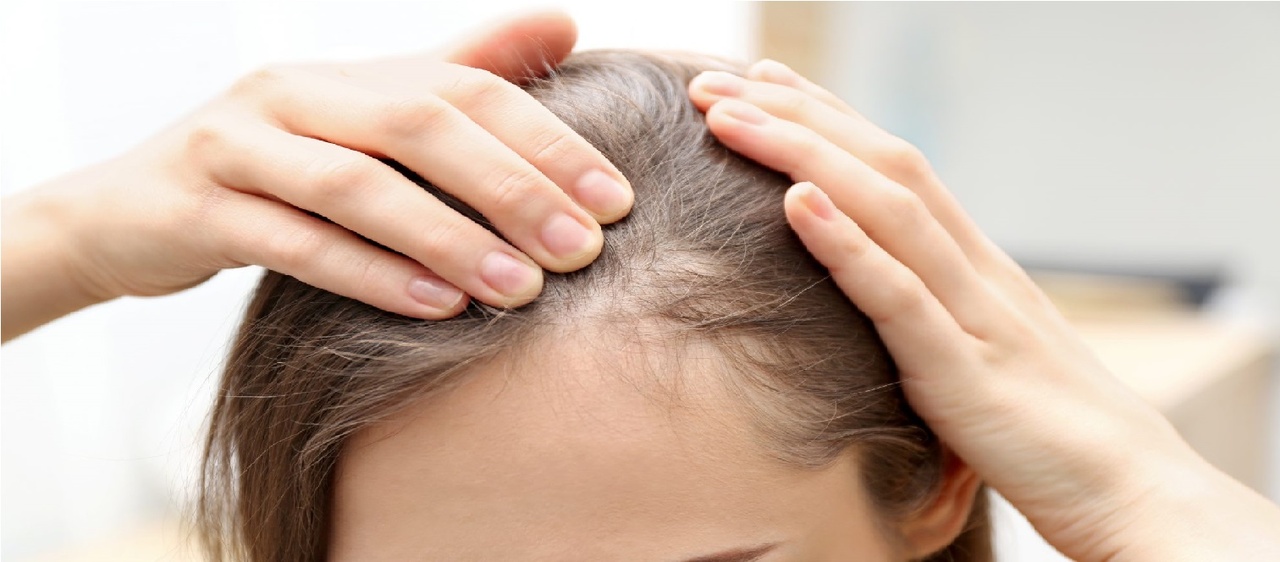 چه چیزهایی ریزش مو را متوقف میکند؟ چه چیزهایی ریزش مو را متوقف میکند؟