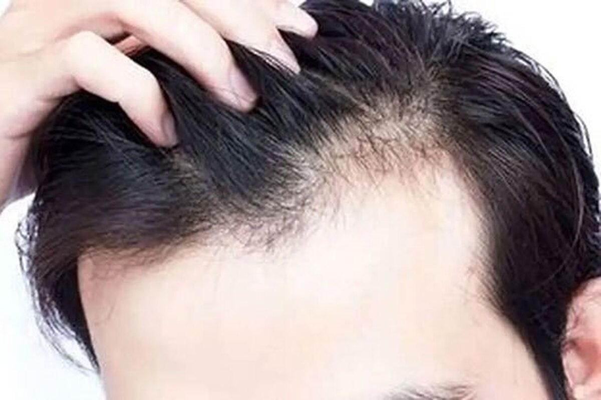 کمبود این ویتامین موجب ریزش مو میشود کمبود این ویتامین موجب ریزش مو میشود