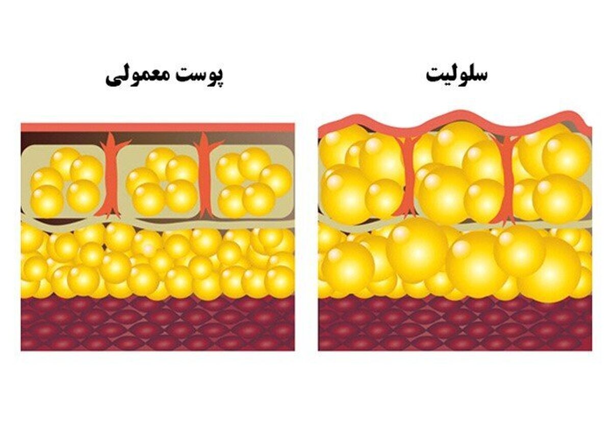 درمانهای خانگی سلولیت که کمتر کسی از آن خبر دارد درمانهای خانگی سلولیت که کمتر کسی از آن خبر دارد