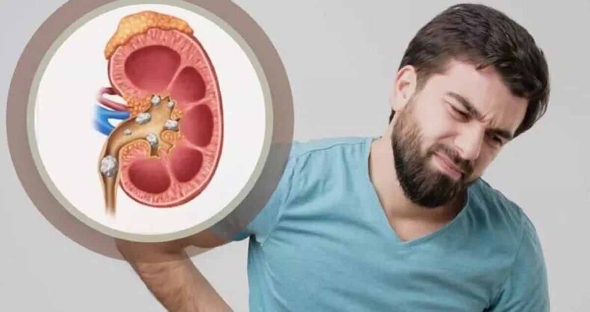 بهترین راهکار برای نجات از درد سنگ کلیه بهترین راهکار برای نجات از درد سنگ کلیه