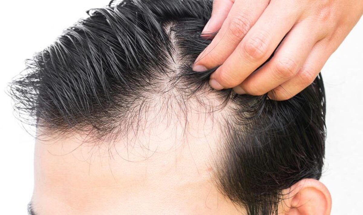 آیا استفاده از ماینوکسیدیل برای افزایش رشد مو بیخطر است؟ آیا استفاده از ماینوکسیدیل برای افزایش رشد مو بیخطر است؟