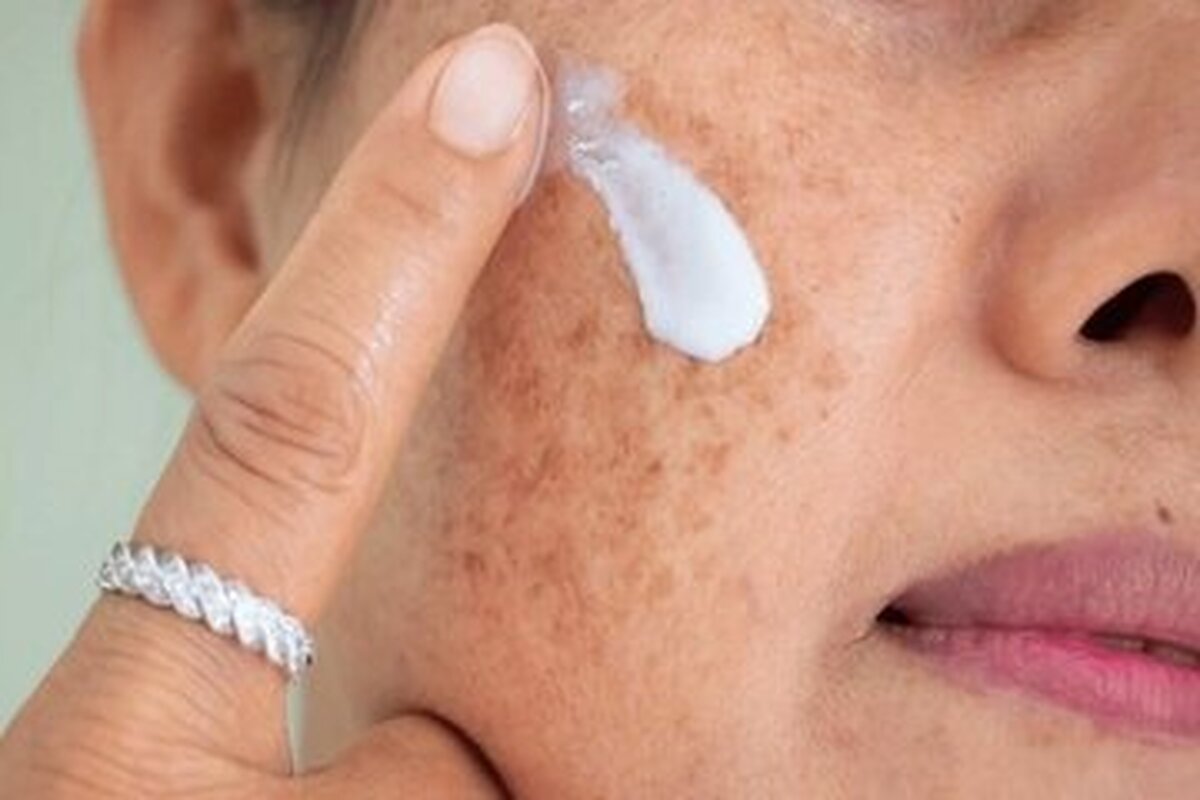 لکههای پوستی را چگونه درمان کنیم؟ لکههای پوستی را چگونه درمان کنیم؟
